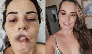 Influencer que perdeu os lábios em 2020 mostra a reconstrução de rosto