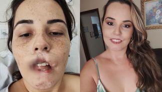 Influencer que perdeu os lábios em 2020 mostra a reconstrução de rosto